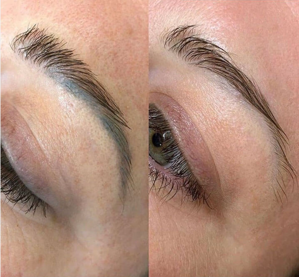 Brow Tattoo Removal Image